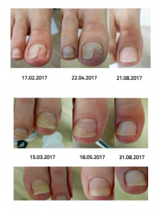 ONYGEN® Krem ŚWIATOWA INNOWACJA !